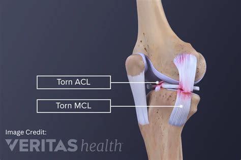 acl mcl tear test|difference between acl and mcl.